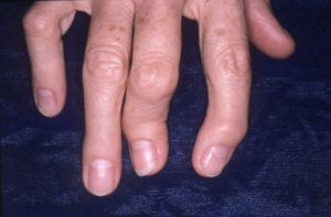 polyosteoarthrosis kezelés