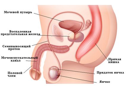 A prosztatagyulladás tünetei férfiaknál
