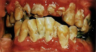 periodontitis fokozat