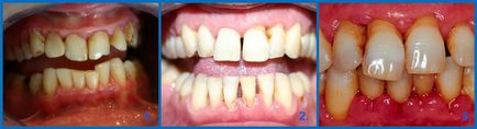 periodontitis fokozat periodontitis fokozat