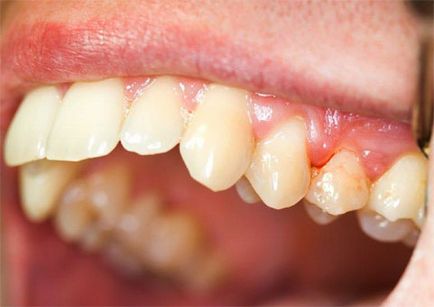 periodontitis fokozat