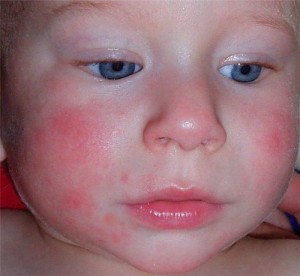 Allergia a gyermek Komorowski