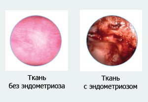 Uzi endometriózis