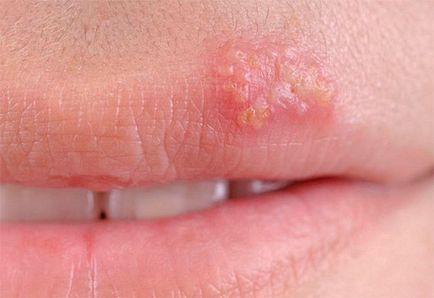 Hogyan lehet gyógyítani herpesz