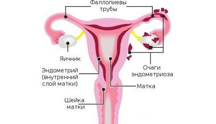 Uzi endometriózis