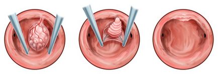 A kezelés után a eltávolítása endometrium polipok