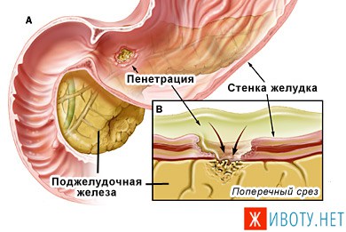 Miért gyomorfájás és vissza