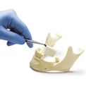 Protézis vagy implantáció Protézis vagy implantáció