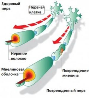 A tünet a sclerosis multiplex