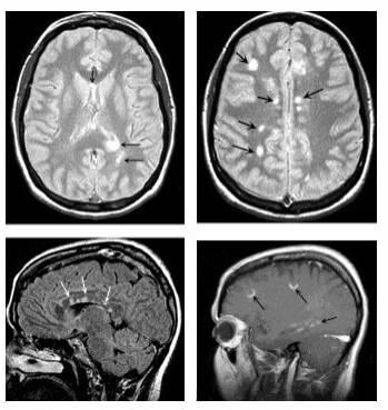 A tünet a sclerosis multiplex