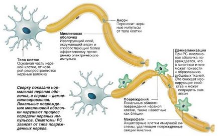 A tünet a sclerosis multiplex