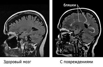 A tünet a sclerosis multiplex