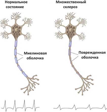 A tünet a sclerosis multiplex