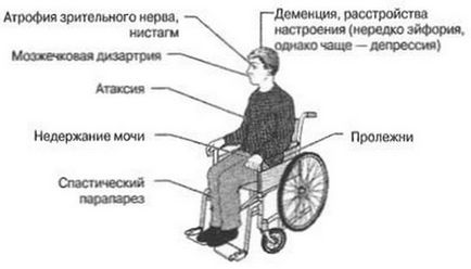 A tünet a sclerosis multiplex