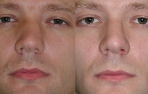 Hogyan erősít az orrsövény Hogyan erősít az orrsövény