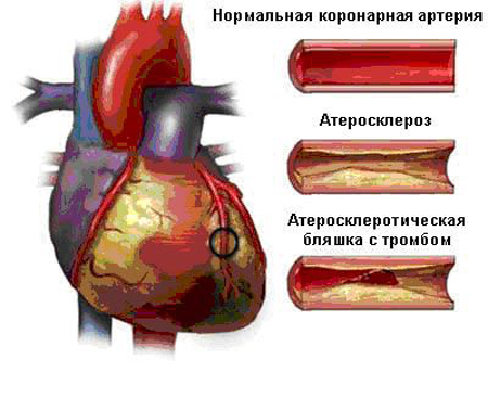 Mi angina szív