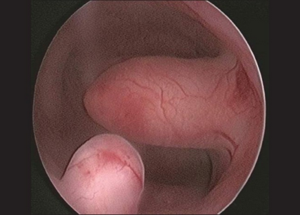 A kezelés után a eltávolítása endometrium polipok