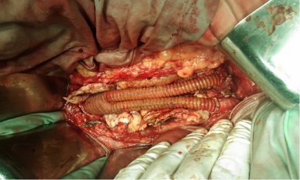 hasi aorta aneurizma kerülnek bevezetésre, hogy a korai tünetek és a kezelés