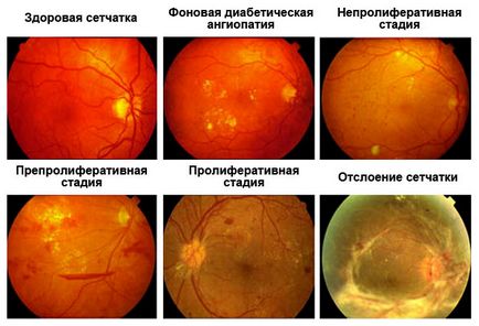 Retina angiopathy mi ez, okai, tünetei és kezelése