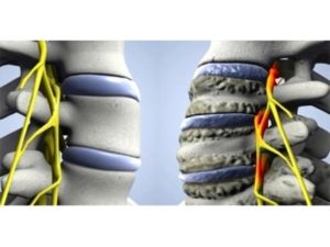 Osteoarthritis a nyaki gerinc okozza, tünetei, kezelése