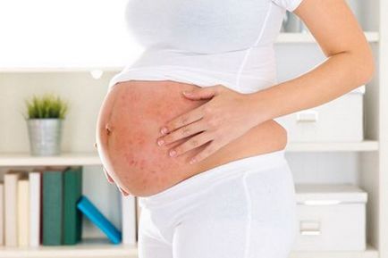 Mi fenyegeti a terhesség és a pszoriázis kezelések a terhesség alatt, a szülés után, mint a pikkelysömör