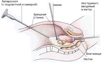 Endometrioid petefészek ciszta okoz, tünetek és a kezelés