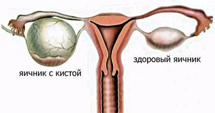 Endometrioid petefészek ciszta okoz, tünetek és a kezelés
