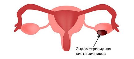 Endometrioid petefészek ciszta - az okok, kezelések, a tünetek