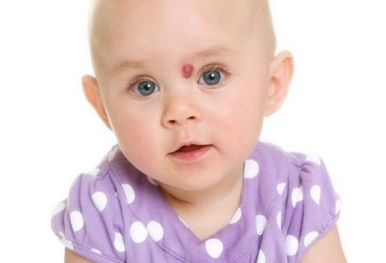 Hemangioma az újszülöttek (18 fotók) okoz, és kezelés, a fej és a fej hátsó részét a mell, arc,