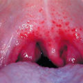 Herpeszes szájgyulladás kezelésére felnőtteknél, okait és tüneteit (fotó)