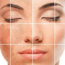 Hyperpigmentation a bőr okoz, kezelés