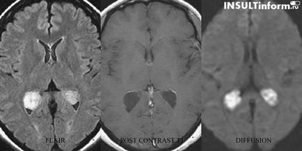 Stroke gyermekek okoz, a tünetek, hatásai és kezelési módszerek