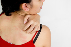Hogyan kell kezelni az allergiás kiütés a felnőttek és gyermekek népi jogorvoslati