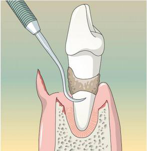 Hogyan kell kezelni a periodontális betegség tüneteit és a betegségek megelőzése