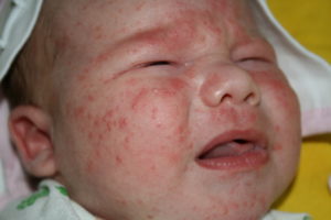 Hogyan állapítható meg, hogy mi az allergia csecsemők - okai, tünetei, diagnózis, kezelés, megelőzés