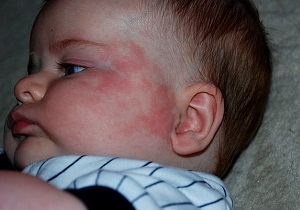Csepp allergiától a különböző korú gyermekek, és egy lista az alkalmazás szabályai