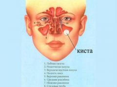 Ciszta az arcüreg tünetek, a jelenlegi kezelések