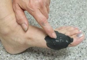Bone egy láb a hüvelykujj kezelésére emberek jogorvoslatok