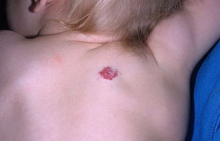 Red anyajegyek - test, az okok a jel veszélyes betegség, fotó
