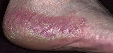 Palmoplantar psoriasis kép, kezelésére emberek jogorvoslatok