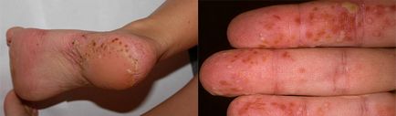 Palmoplantar psoriasis kép, kezelésére emberek jogorvoslatok