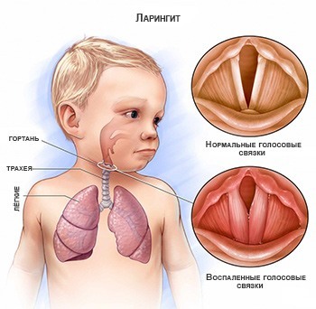 Gégegyulladás gyermekek tünetei és kezelése otthon