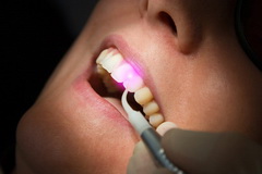 Laser Dentistry - jellemzőit, előnyeit, jelzések