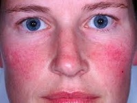 A rosacea kezelésének az arcon népi jogorvoslat, a hagyományos orvoslás (rosacea kezelésére arcbőr betegség népi jogorvoslati tüneteinek kezelésére a betegség maszkok) A rosacea kezelésének az arcon népi jogorvoslat, a hagyományos orvoslás