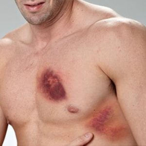 A kezelés sérülések, a kezek, csuklók, fej, nyak, hát, mellkas és az ujjak, hogyan kell kezelni a sérülések a (vissza) A kezelés sérülések, a kezek, csuklók, fej, nyak, hát, mellkas és az ujjak, hogyan kell kezelni sérülések