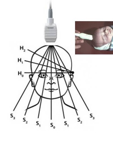 Neurosonography újszülött olvasás, dekódolási eredmények (újszülöttek) Neurosonography újszülött olvasás, dekódolás eredménye