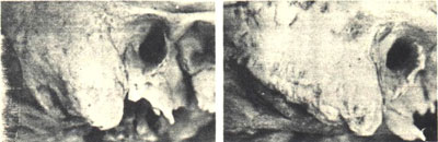 Mastoid régió - orvostudomány (hátsó külső fala) Mastoid régió - az orvostudomány