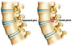 Osteochondrosis nyaki osztályának váll kezelése és okai