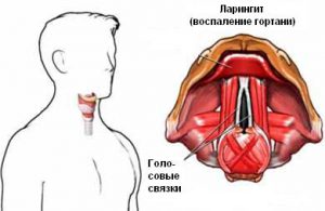 Gégeoedema tünetei és kezelése a gyermek és felnőtt