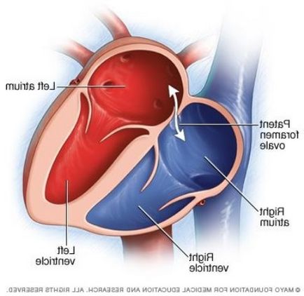 Nyitott foramen ovale, a szívében egy gyermek a csecsemőknél és újszülött lyuk, a szív